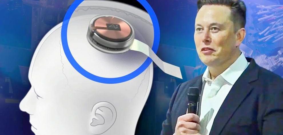 Elon Musk agy chip - Neuralink chip